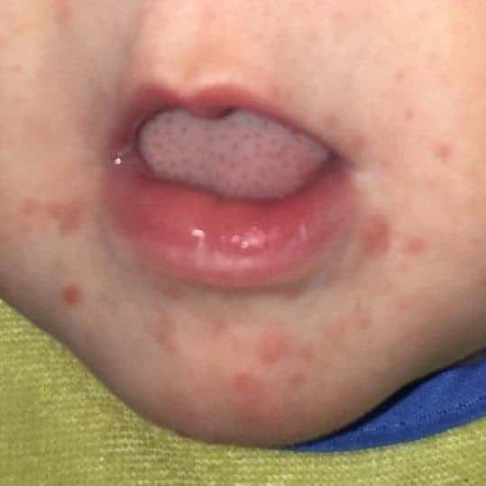 little-red-spots-on-toddlers-lips-infoupdate