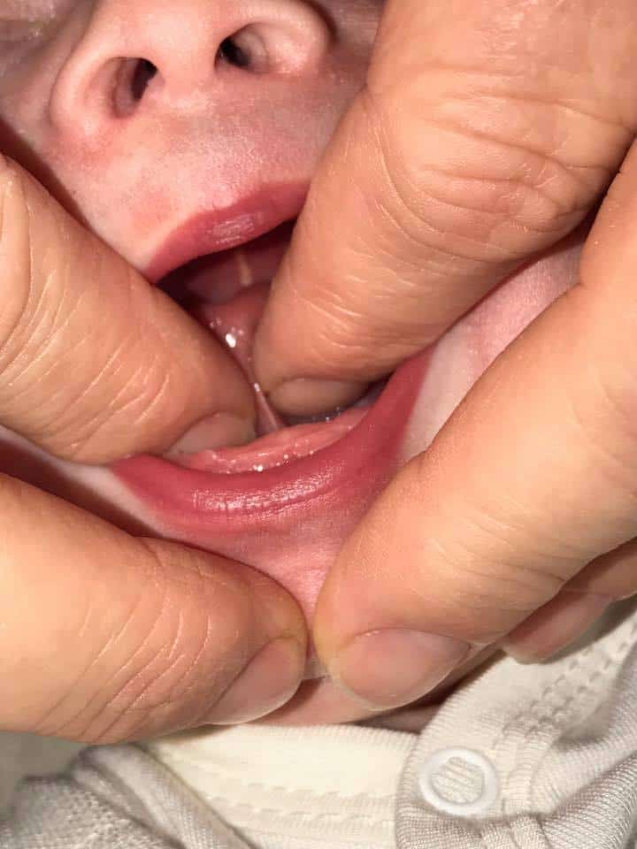 close up example of a baby with a posterior tongue tie