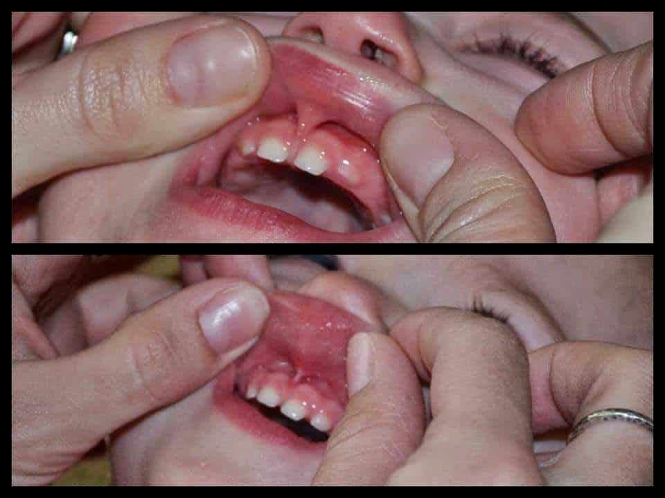 before and after lip tied baby examples