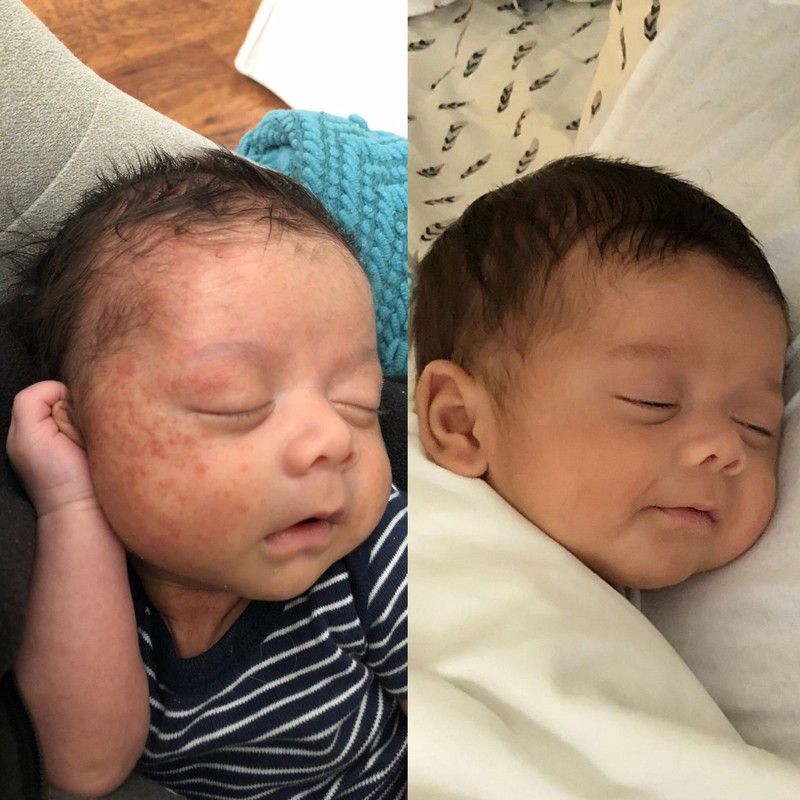 Baby with and without baby acne