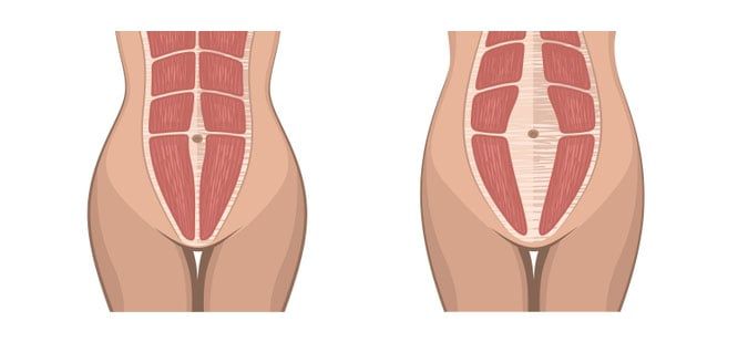 Diastasis Recti example