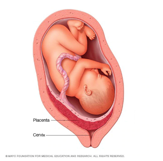 medical illustration of placenta pervia