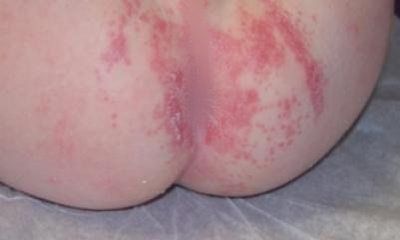 child with a yeast rash on their bum