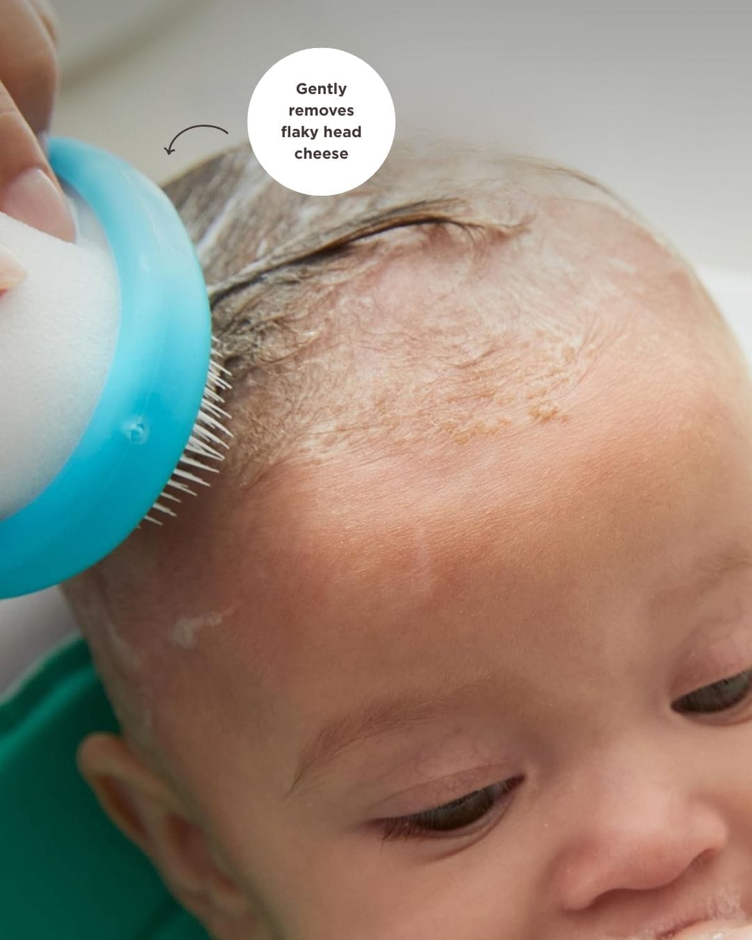 DermaFrida The FlakeFixer on baby's head