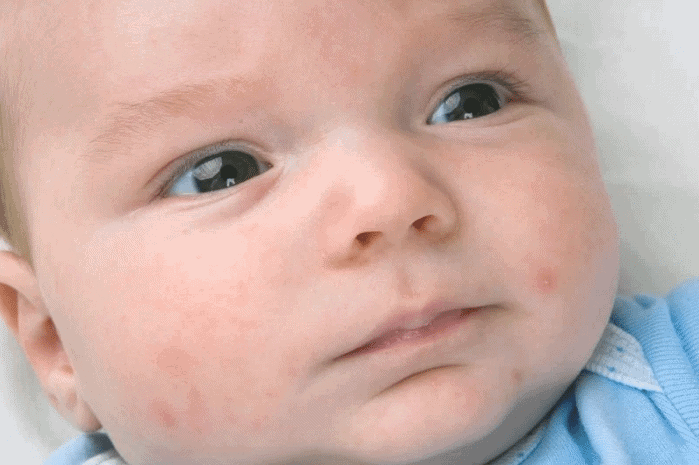 Types of Baby Rashes