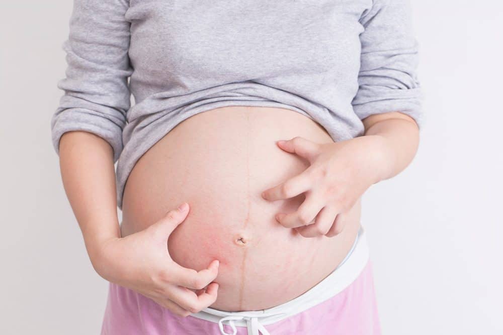 A pregnant person scratching a red, itchy rash on their bare stomach and around stretch marks.