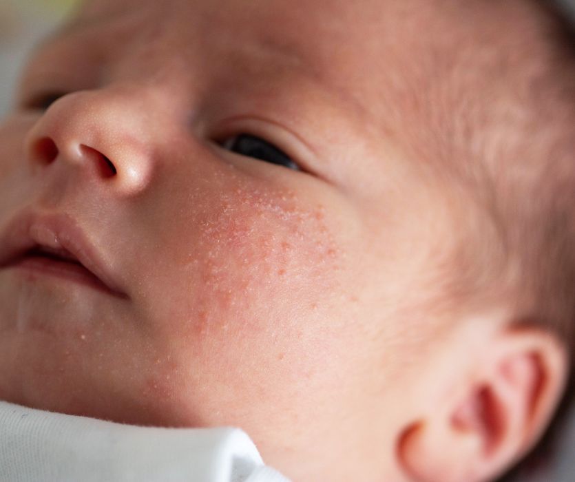 Close-up of a newborn baby's face featuring a cluster of small red bumps and dry skin on the cheek.