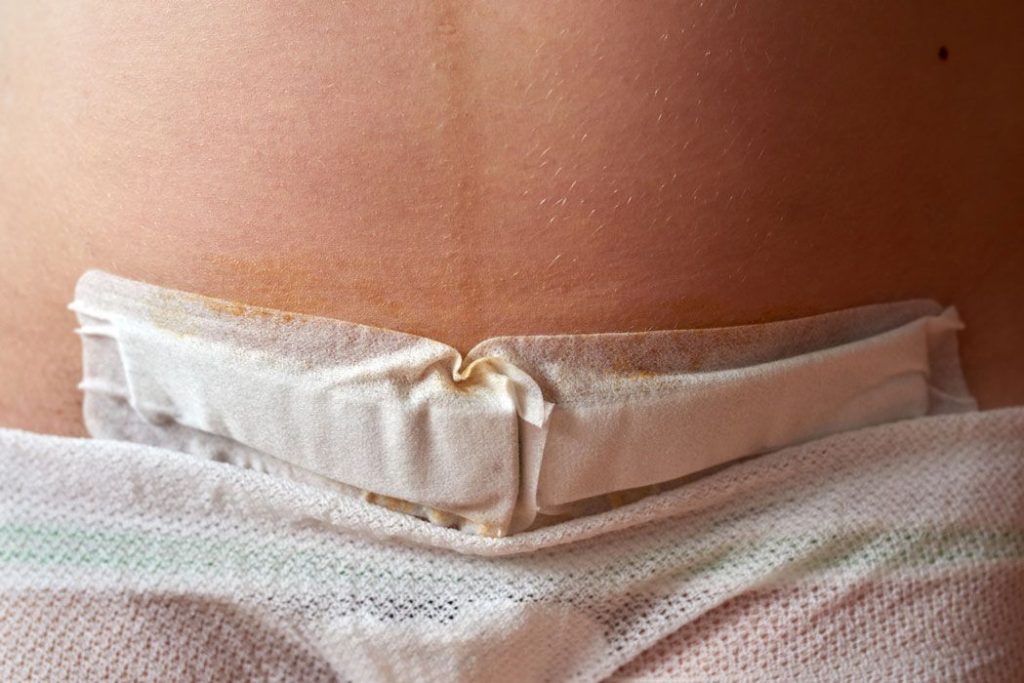 Close-up of a white horizontal surgical bandage covering a C-section incision on a person's lower abdomen.