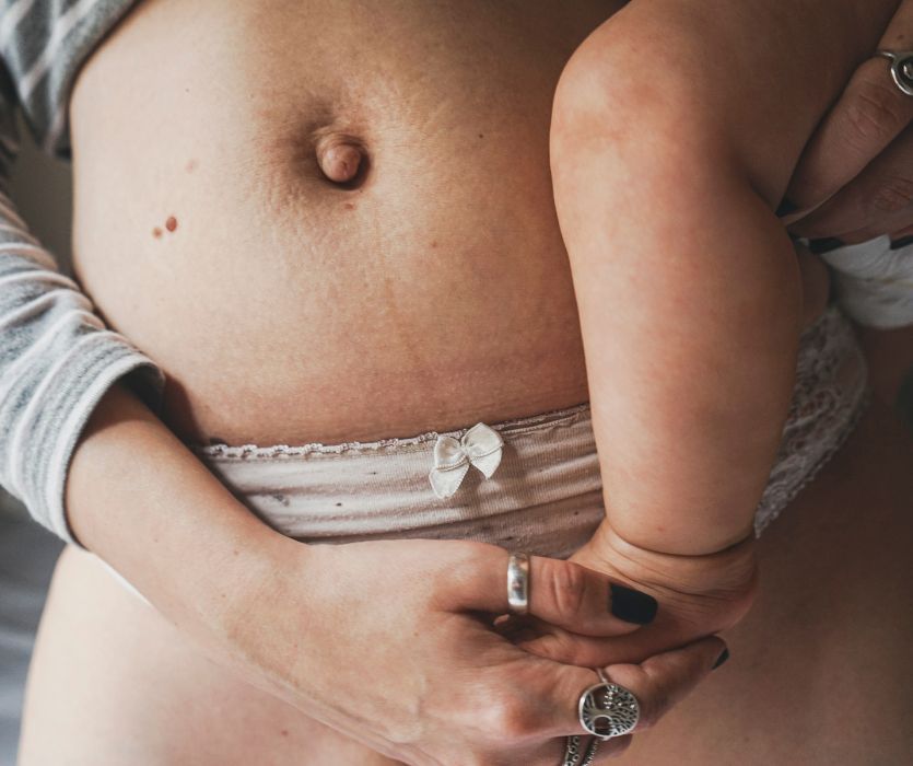 Close-up of a postpartum belly with stretch marks and a mole, held by hands alongside a baby's leg.