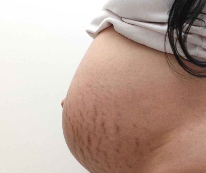 Side profile of a pregnant abdomen featuring vertical reddish-brown stretch marks during the later stages of pregnancy.